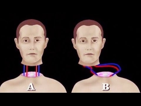 شاهد ماذا سيحدث إذا تم نقل رأسك إلى جسد جديد